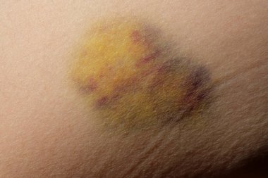 Bir köpek ısırığının neden olduğu derideki çürükleri gösteren yakın plan bir resim. Etkilenen bölgenin rengini ve dokusunu vurguluyor.