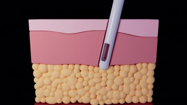 Animation Shows Concept Fat Transfer Treatment — Stock Video