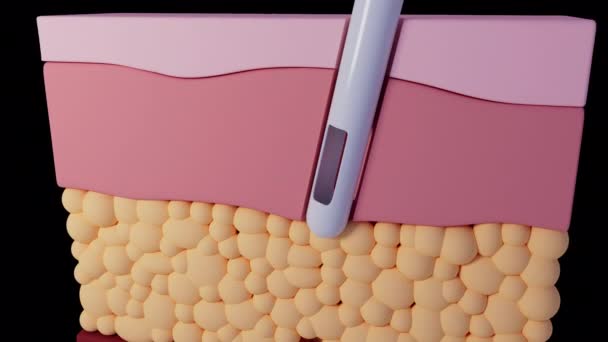 Denna Animation Visar Begreppet Fettsugning — Stockvideo