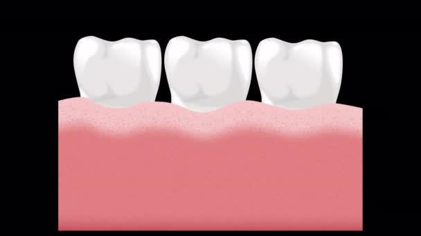 Анімація Показує Формування Зубного Каменю Зубах — стокове відео