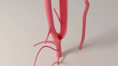 This 3d animation shows the surgical removal of a brain clot