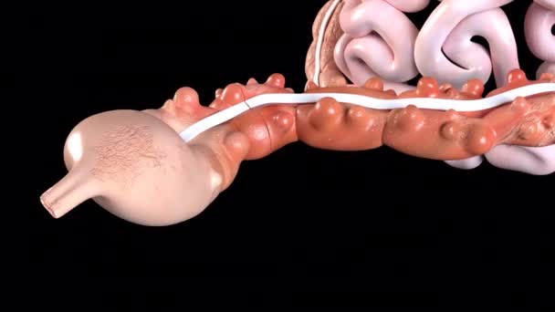 Video Shows Colonic Diverticulosis — Stock Video