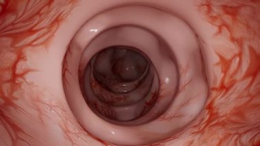 Bu 3d video kolonda divertikül oluşumunu gösterir