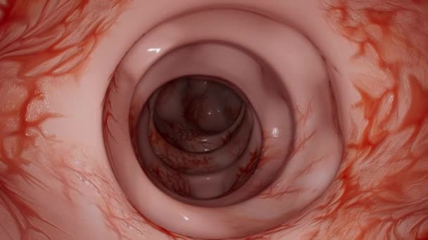 Video Shows Formation Diverticula Colon — Stock Video