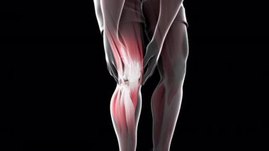 Bu 3 boyutlu animasyon, diz ağrısı çeken bir adamı gösteriyor.