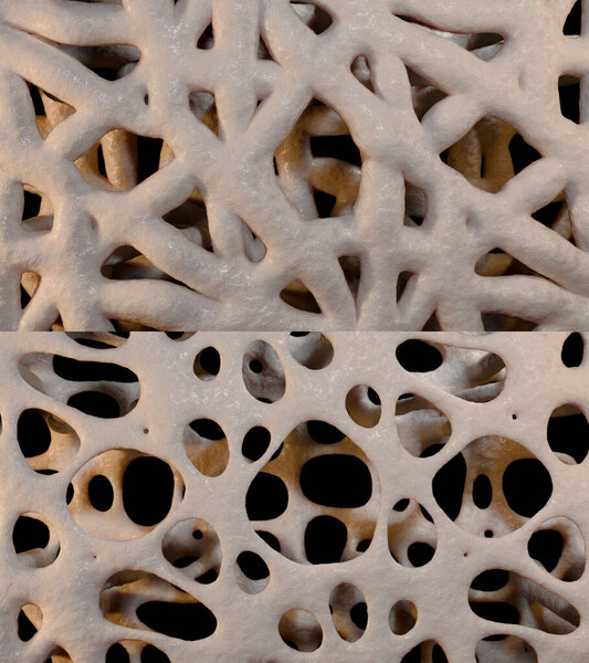 Эта трехмерная иллюстрация показывает истончение костей, вызванное остеопорозом