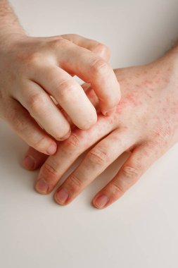 Erkek eller deride kaşındıran kırmızı noktalar çiziyor. Yanlış diyetten kaynaklanan alerji reaksiyonu, antibiyotik ya da ilaçların etkisi. Deri hastalığı