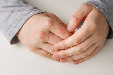 Erkek elleri beyaz masada, derisinde kırmızı lekeler var. Alerjik reaksiyon, deri problemleri, cilt bakımı. Yanlış diyet, ilaç almanın yan etkisi.