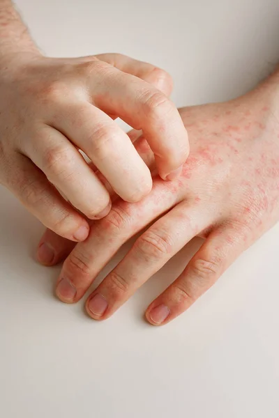 Male hands scratching itchy red spots on skin. Allergy reaction from wrong diet, by-effect from taking antibiotics or medicines. Skin disease