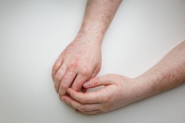 Alerji, beyaz masadaki erkek ellerinde kızarıklık. Dermatolojik sorun, hastanın deri semptomu. Yakın çekim.