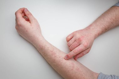 Hastanın ellerinde ve kollarında kızarıklık var. Deri iltihabı, egzama, dermatolojik sorun, deri tedavisi ve sağlık hizmetleri. Üst görünüm