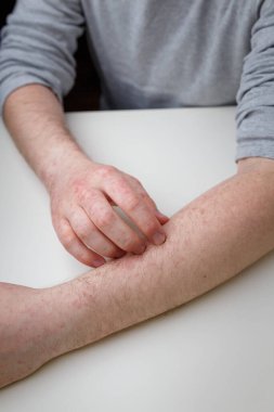 Kolunu kaşındıran kırmızı kaşıntı, iddia edilen deri iltihabı ya da acı veren diğer deri hastalıklarıyla kaşıyan bir adam. Dermatoloji ve cilt sağlığı hizmetleri