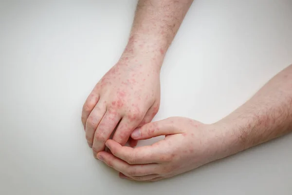 Allergy Red Itchy Rash Male Hands White Table Dermatological Problem — стоковое фото
