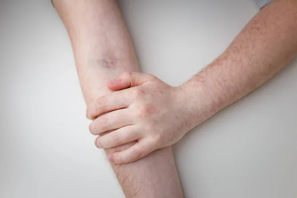 Male Arm Syringe Injection Mark Vaccine Reddening Reaction Rash Effect — Fotografia de Stock