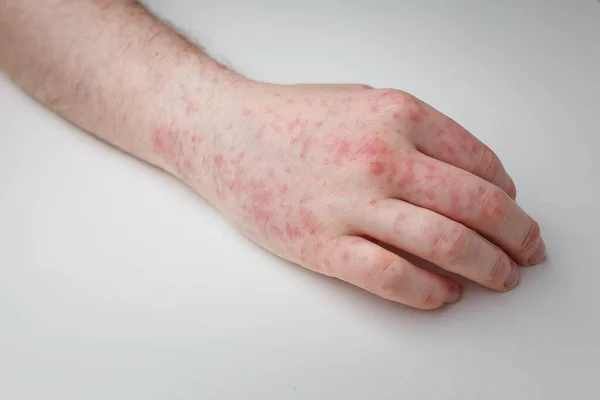 Allergy, red itchy rash on male hand on white table. Dermatological problem, skin symptom of patient. Close up shot