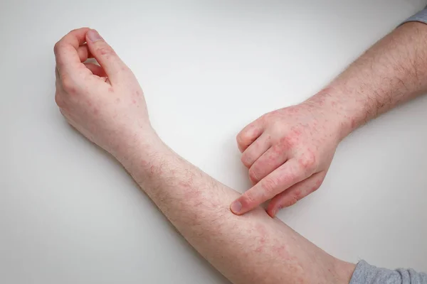 Pacjent Czerwoną Swędzącą Wysypkę Rękach Rękach Zapalenie Skóry Wyprysk Problem Obraz Stockowy