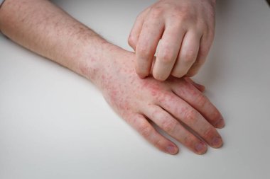 Finger scratching hands with allergic red rash. Derma disease with painful itchy sores. Two hands of patient on white table, top view
