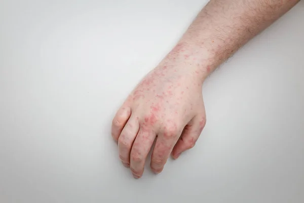 Patient shows arm and hand with red itchy painful rash. Allergic symptom on male hands. Dermatology, skin care. White background, top view