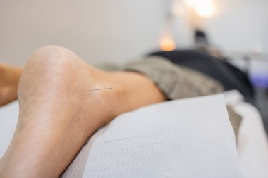 Hasta muayene masasında yatıyor. Klinikteki ağrı kesici, sağlık ve bütünsel ayak terapisi için topuğuna iğne batırılmış geleneksel Çin akupunkturunu alıyor.