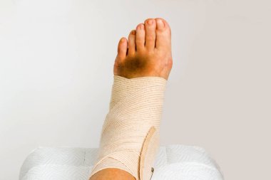 Tıbbi bandaj doğru sarılmış, sol ayak bileği burkulmuş, yakın çekim