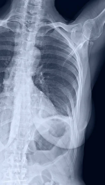 Sahilin Göğüs Kemiğinin Köprücük Kemiğinin Röntgeni Sol Taraftaki Sekizinci Kaburga — Stok fotoğraf