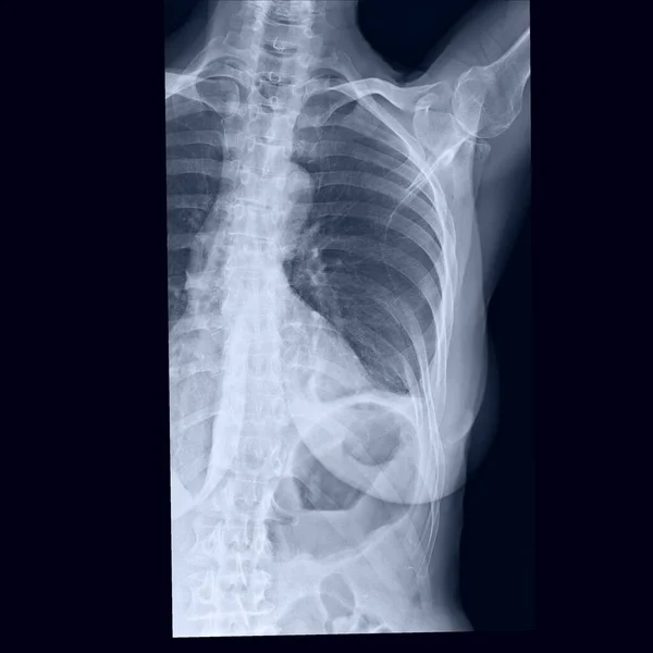 Sahilin Göğüs Kemiğinin Köprücük Kemiğinin Röntgeni Sol Taraftaki Sekizinci Kaburga — Stok fotoğraf