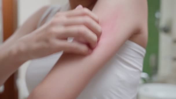 Проблемы Кожи Красоты Молодая Женщина Царапает Тело Зуд Кожи Аллергии — стоковое видео