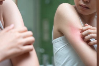Cilt sorunu ve güzellik. Cilt alerjisi, steroid alerjisi, hassas cilt, güneş yanığı, kimyasal alerji, isilik, böcek ısırığı, Seborrheic Dermatitis..