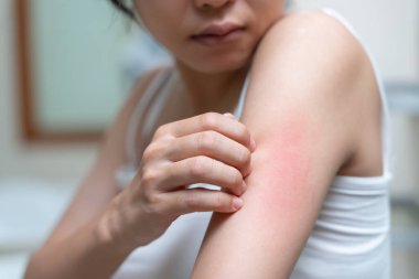 Cilt sorunu ve güzellik. Cilt alerjisi, steroid alerjisi, hassas cilt, güneş yanığı, kimyasal alerji, isilik, böcek ısırığı, Seborrheic Dermatitis..