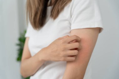 Cilt sorunu ve güzellik. Cilt alerjisi, steroid alerjisi, hassas cilt, güneş yanığı, kimyasal alerji, isilik, böcek ısırığı, Seborrheic Dermatitis..