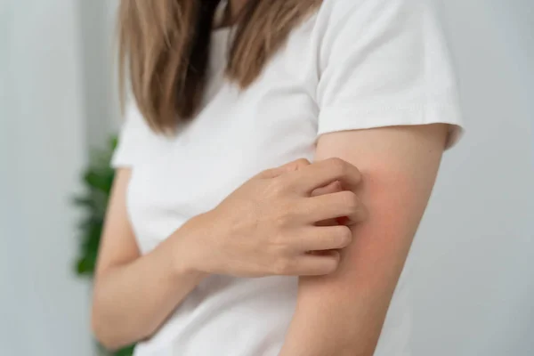 stock image skin problem and beauty. Young woman scratch body has itchy skin from skin allergic, steroid allergy, sensitive skin, red from sunburn, chemical allergy, rash, insect bites, Seborrheic Dermatitis.