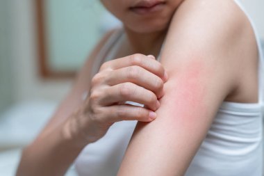 Cilt sorunu ve güzellik. Cilt alerjisi, steroid alerjisi, hassas cilt, güneş yanığı, kimyasal alerji, isilik, böcek ısırığı, Seborrheic Dermatitis..