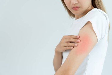Cilt sorunu ve güzellik. Cilt alerjisi, steroid alerjisi, hassas cilt, güneş yanığı, kimyasal alerji, isilik, böcek ısırığı, Seborrheic Dermatitis.