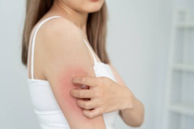 Cilt sorunu ve güzellik. Cilt alerjisi, steroid alerjisi, hassas cilt, güneş yanığı, kimyasal alerji, isilik, böcek ısırığı, Seborrheic Dermatitis..