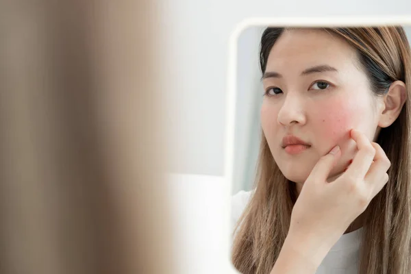 Wanita Muda Khawatir Tentang Wajah Dermatologi Dan Alergi Terhadap Steroid — Stok Foto