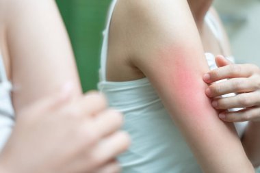 Cilt sorunu ve güzellik. Cilt alerjisi, steroid alerjisi, hassas cilt, güneş yanığı, kimyasal alerji, isilik, böcek ısırığı, Seborrheic Dermatitis.