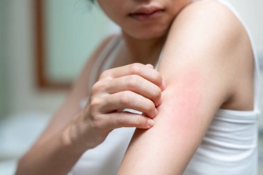 Cilt sorunu ve güzellik. Cilt alerjisi, steroid alerjisi, hassas cilt, güneş yanığı, kimyasal alerji, isilik, böcek ısırığı, Seborrheic Dermatitis..