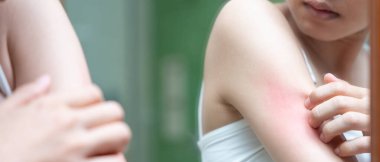 Cilt sorunu ve güzellik. Cilt alerjisi, steroid alerjisi, hassas cilt, güneş yanığı, kimyasal alerji, isilik, böcek ısırığı, Seborrheic Dermatitis..