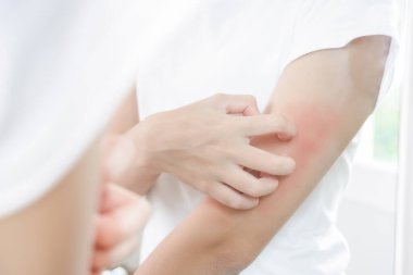 Cilt sorunu ve güzellik. Cilt alerjisi, steroid alerjisi, hassas cilt, güneş yanığı, kimyasal alerji, isilik, böcek ısırığı, Seborrheic Dermatitis..