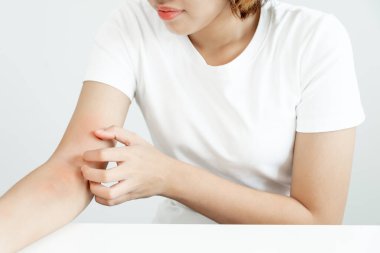 Cilt sorunu ve güzellik. Cilt alerjisi, steroid alerjisi, hassas cilt, güneş yanığı, kimyasal alerji, isilik, böcek ısırığı, Seborrheic Dermatitis..