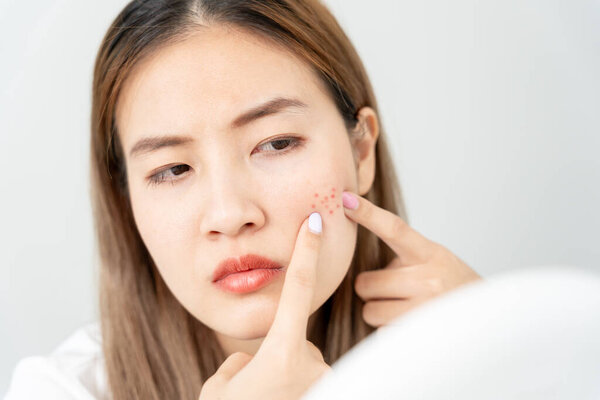 Young woman are worried about faces Dermatology and allergic to steroids in cosmetics. sensitive skin, red face from sunburn, acne, allergic to chemicals, rash on face. skin problems and beaut