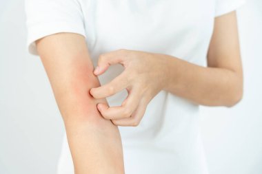 Cilt sorunu ve güzellik. Cilt alerjisi, steroid alerjisi, hassas cilt, güneş yanığı, kimyasal alerji, isilik, böcek ısırığı, Seborrheic Dermatitis..