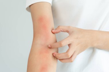 Cilt sorunu ve güzellik. Cilt alerjisi, steroid alerjisi, hassas cilt, güneş yanığı, kimyasal alerji, isilik, böcek ısırığı, Seborrheic Dermatitis.