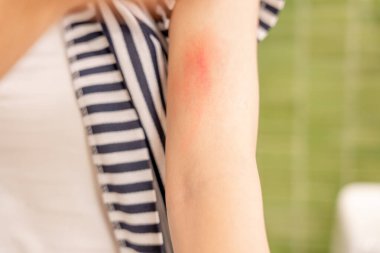 Cilt sorunu ve güzellik. Cilt alerjisi, steroid alerjisi, hassas cilt, güneş yanığı, kimyasal alerji, isilik, böcek ısırığı, Seborrheic Dermatitis..