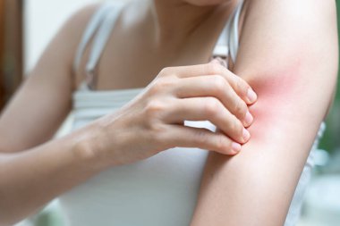 Cilt sorunu ve güzellik. Cilt alerjisi, steroid alerjisi, hassas cilt, güneş yanığı, kimyasal alerji, isilik, böcek ısırığı, Seborrheic Dermatitis.