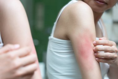 Cilt sorunu ve güzellik. Cilt alerjisi, steroid alerjisi, hassas cilt, güneş yanığı, kimyasal alerji, isilik, böcek ısırığı, Seborrheic Dermatitis..