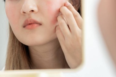 Asyalı kadın yüz dermatolojisi ve kozmetik ürünlerinde steroidlere alerjisi olduğu için endişeli. Hassas cilt, güneş yanığı, sivilce, kimyasallara alerjisi, yüzünde kızarıklık. cilt sorunları ve güzellik