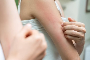 Cilt sorunu ve güzellik. Cilt alerjisi, steroid alerjisi, hassas cilt, güneş yanığı, kimyasal alerji, isilik, böcek ısırığı, Seborrheic Dermatitis..