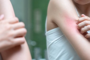 Cilt sorunu ve güzellik. Cilt alerjisi, steroid alerjisi, hassas cilt, güneş yanığı, kimyasal alerji, isilik, böcek ısırığı, Seborrheic Dermatitis.