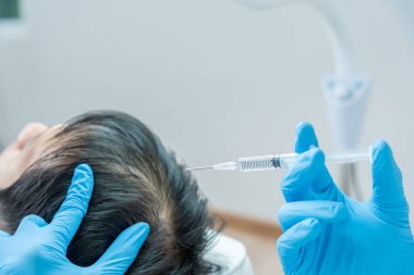 Asyalı erkek için saç enjeksiyonu, saç dökülmesi, saç dökülmesi, seyreltme, vitamin eksikliği, kellik, doğum sonrası, biyotin, çinko, endokrin bozuklukları, hormonal dengesizlik uzmanı.